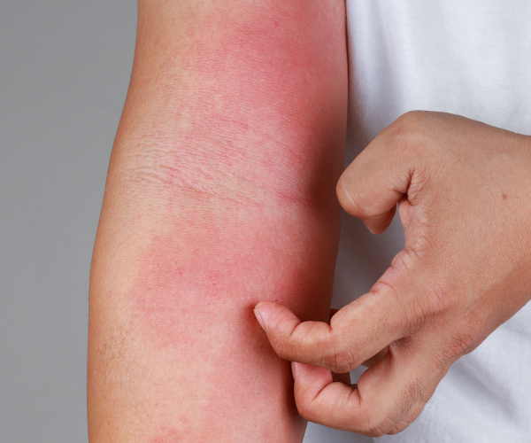 a-conscientizacao-sobre-a-dermatite-atopica