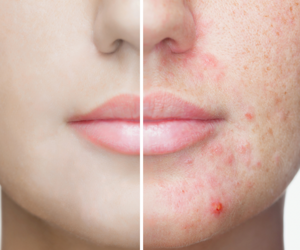 voce-acha-que-a-maquiagem-pode-dar-acne