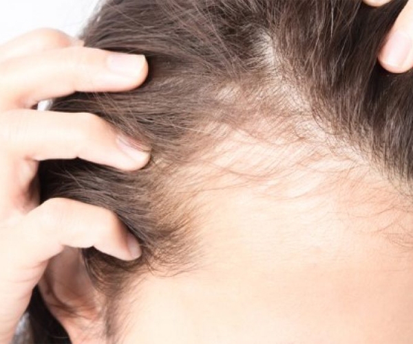 alopecia-androgenetica