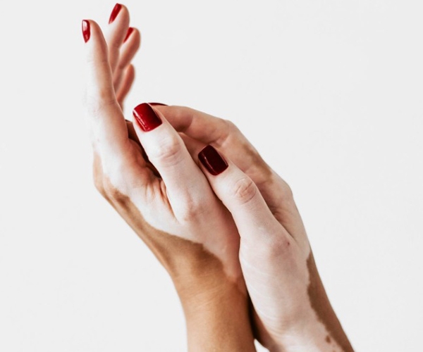 tratamento-para-vitiligo